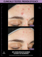 kojic acid serum for acne
