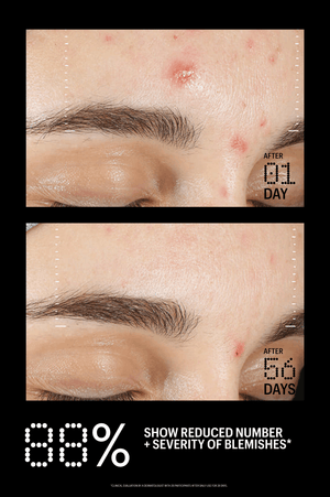 Azelaic & Kojic Advanced Clarifying Serum