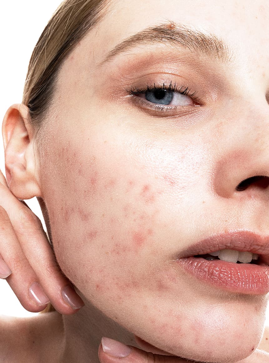 allies of skin azelaic acid anti blemish foundation skinfinish